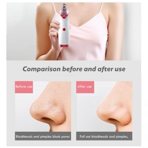 Blackhead Remover